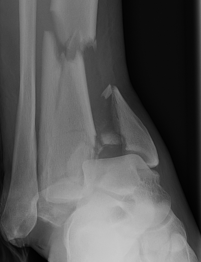 Severe Tibial Plafond